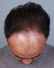 Before Hair Transplant&nbsp;Front